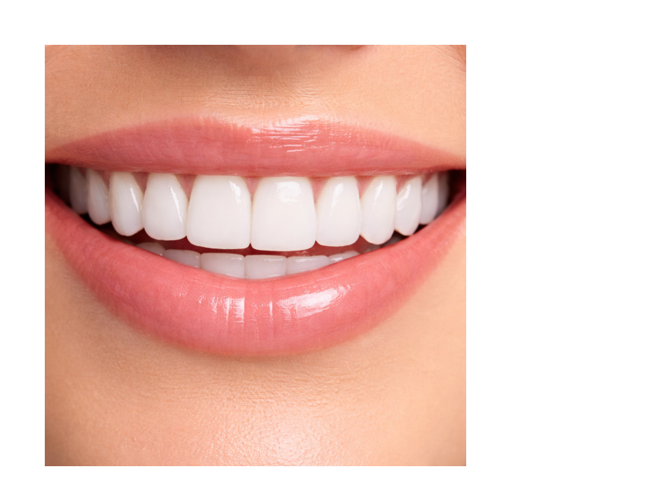 Zirconia Veneers